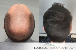 Hair Transplant & Restoration Clinic - Natural Transplants