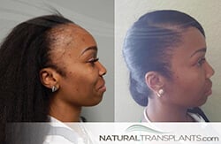Best Hair Transplant Visalia, California | Hair Replacement Experts