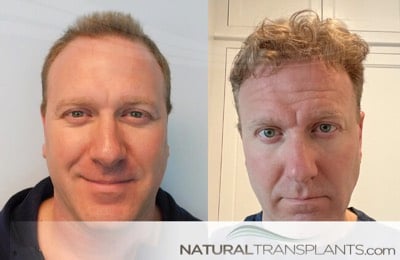 Fort Lauderdale, FL | Hair Transplant & Restoration - Natural Transplants