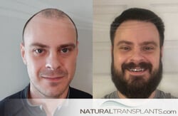 Best Hair Transplant Portland, Oregon | Hair Replacement Experts