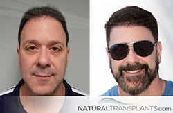 Best Hair Transplant Portland, Oregon | Hair Replacement Experts