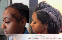 Hair Transplantation WordPress Theme - TemplateMonster