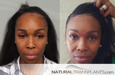 https://naturaltransplants.com/results/hair-transplant-before-and-after/files/hair-loss-in-women.jpg