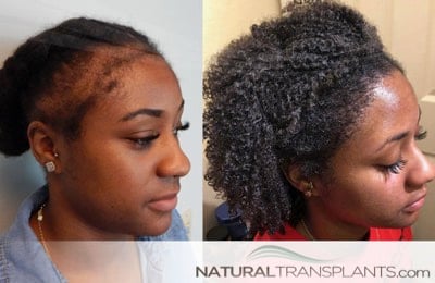 Hair Transplants for Women - Natural Transplants