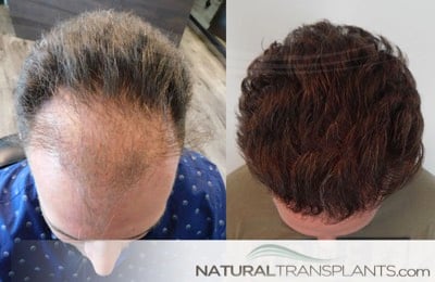 cost of hair transplant
