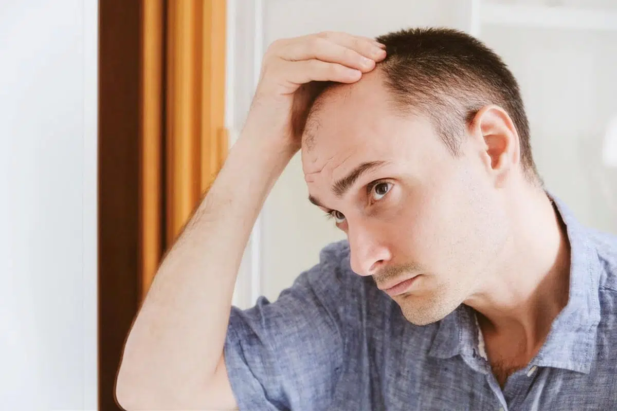 Read more about the article What Age Do Men Start Losing Hair? A Guide For Male Hair Loss