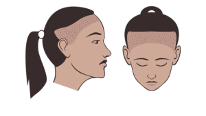 women's traction alopecia