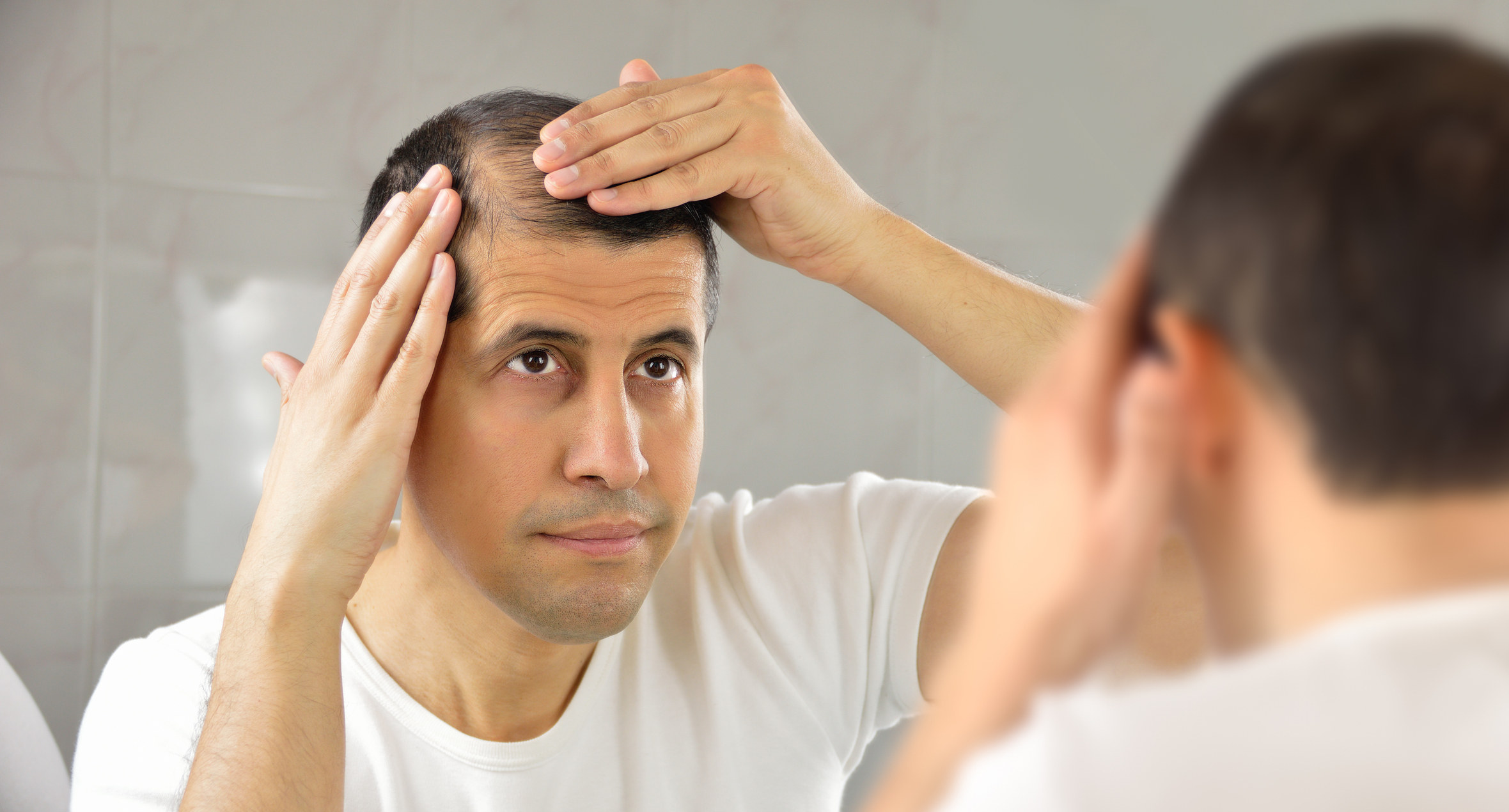Read more about the article Are Testosterone And Hair Loss Related? 
