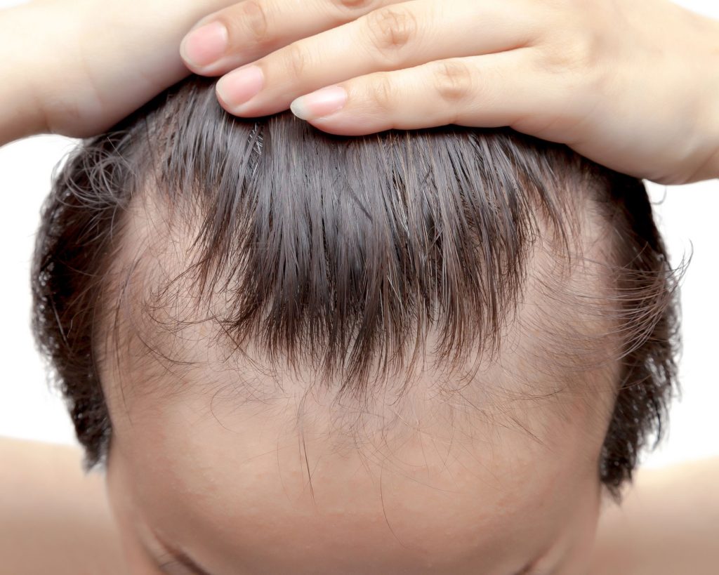 how to prevent a receding hairline