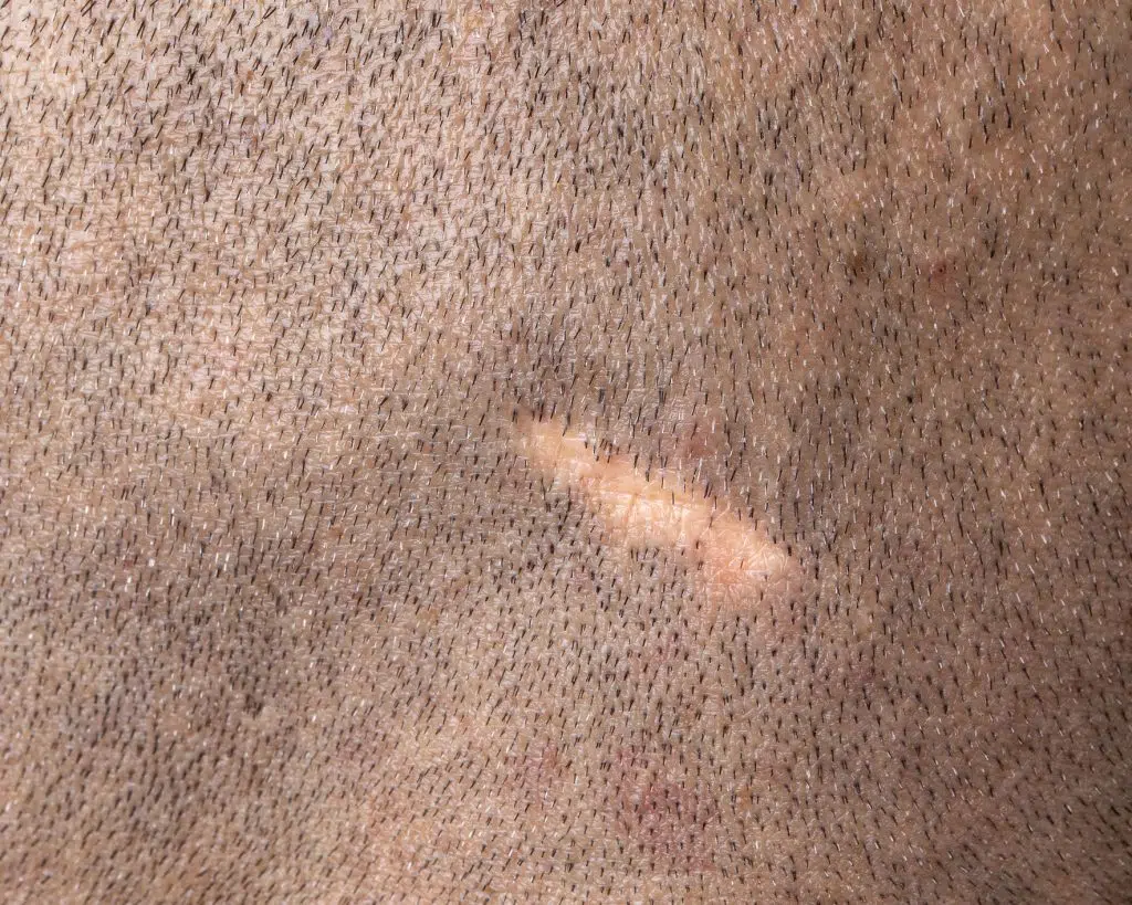 scalp revision