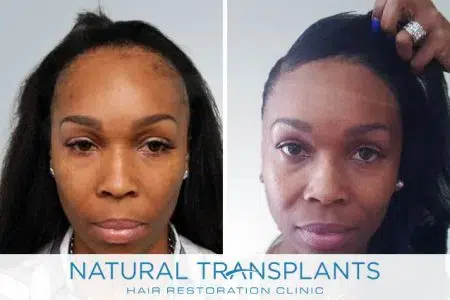female-hair-transplant-1