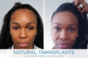 Female Hair Transplant