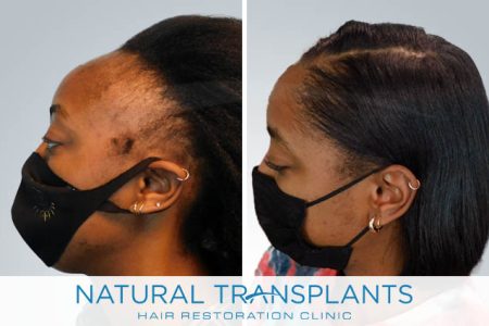 female-hair-transplant-100