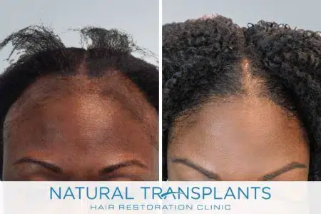 female-hair-transplant-18