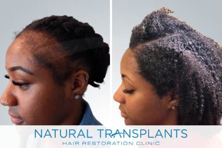 female-hair-transplant-20