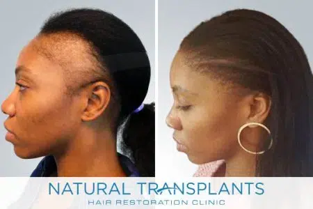 female-hair-transplant-24