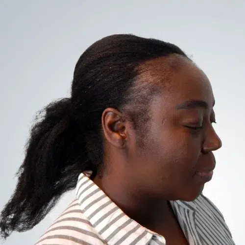 mateyena before-women hair transplant
