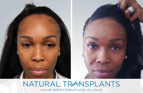 Female Hair Transplant