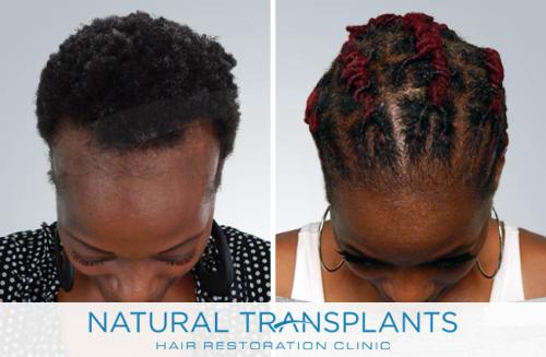 Female Hair Transplant