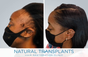 Female Hair Transplant