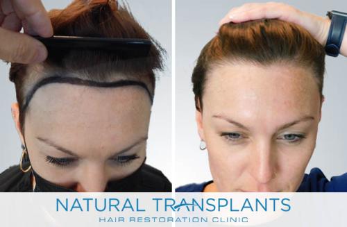 Female Hair Transplant