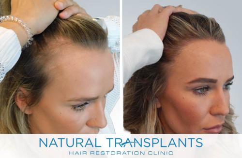 Female Hair Transplant