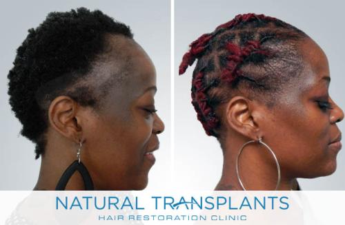 Female Hair Transplant