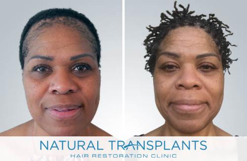 Female Hair Transplant