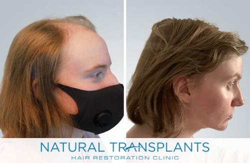 Female Hair Transplant