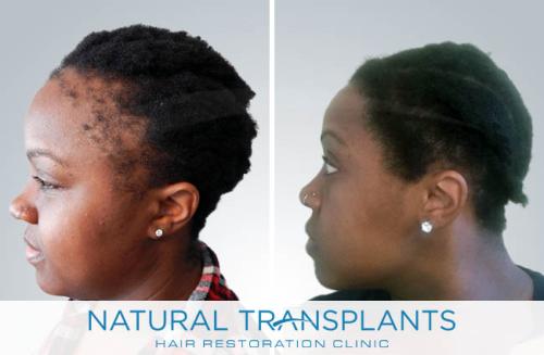 Female Hair Transplant