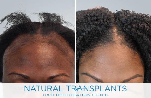 Female Hair Transplant