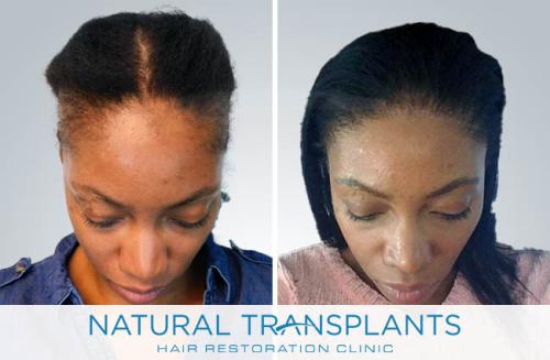 Female Hair Transplant