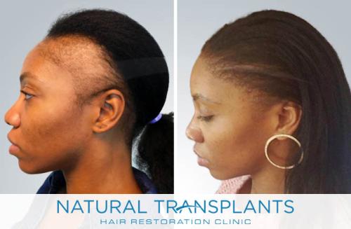 Female Hair Transplant