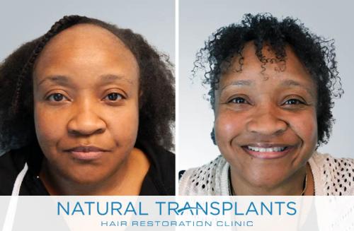 Female Hair Transplant