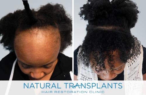 Female Hair Transplant