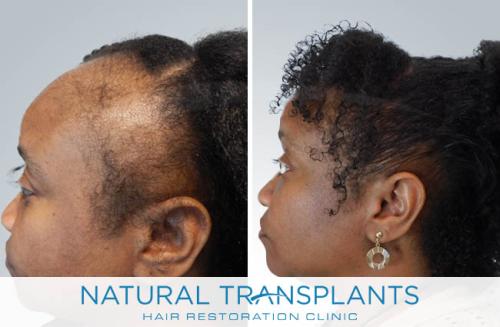 Female Hair Transplant