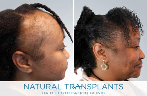 Female Hair Transplant