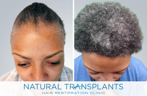 Female Hair Transplant