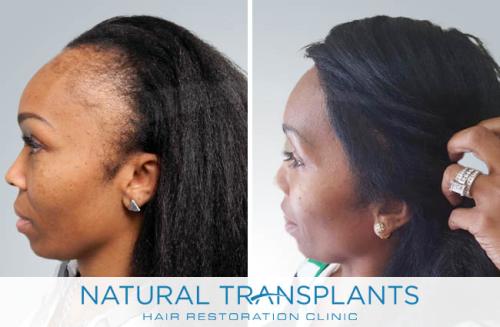 Female Hair Transplant