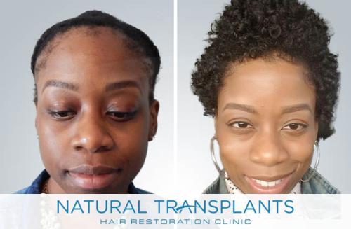 Female Hair Transplant