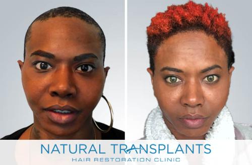 Female Hair Transplant