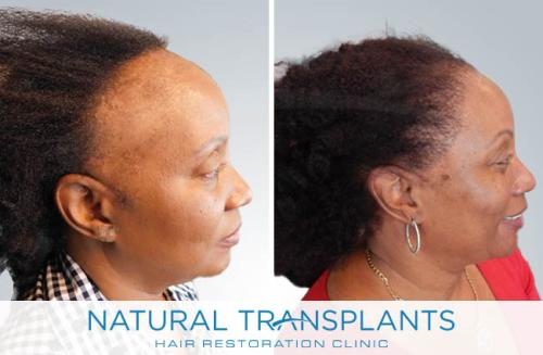 Female Hair Transplant