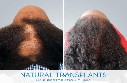 Female Hair Transplant