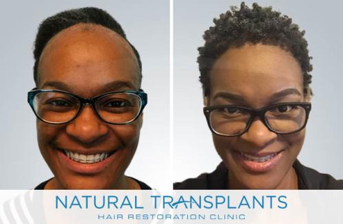 Female Hair Transplant