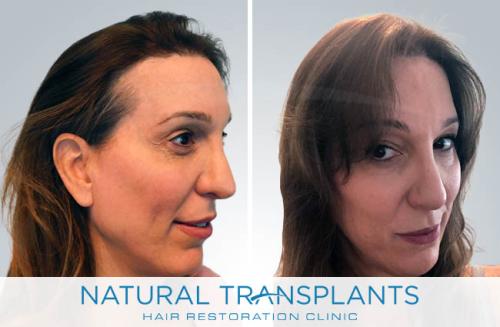 Female Hair Transplant