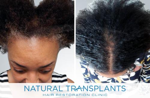 Female Hair Transplant