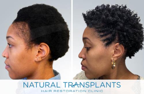 Female Hair Transplant