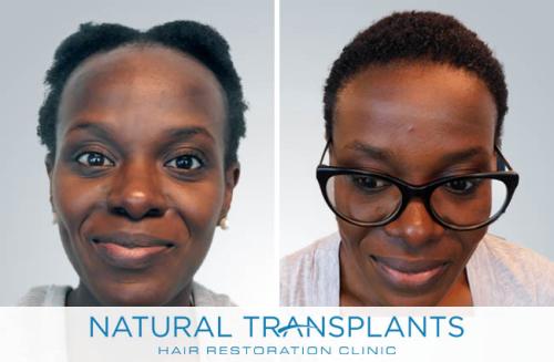 Female Hair Transplant