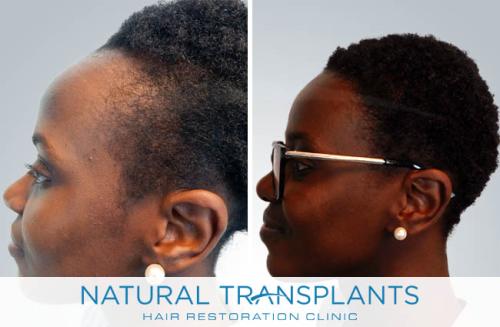 Female Hair Transplant