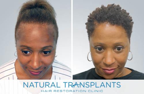 Female Hair Transplant